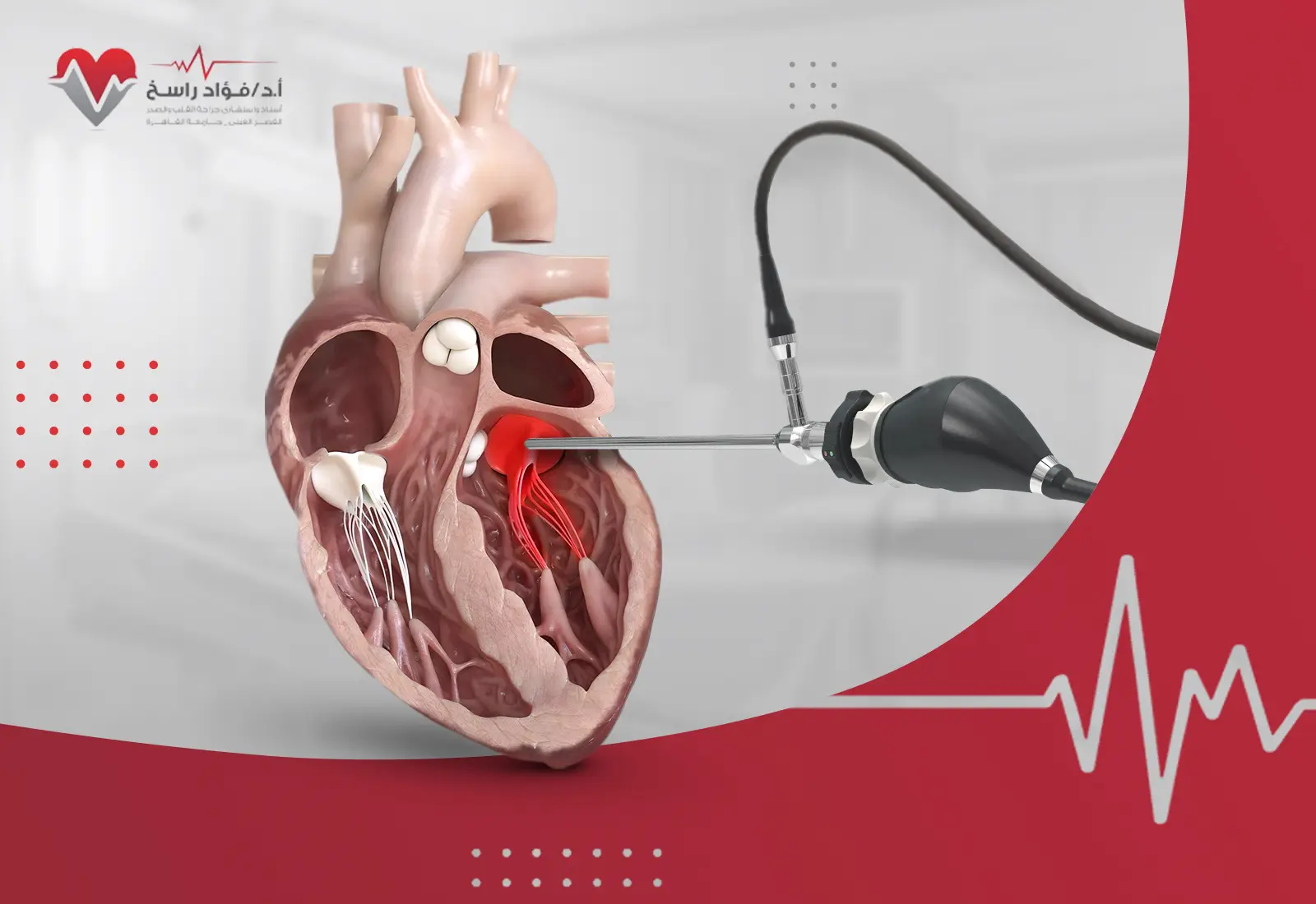 تغيير الصمام الميترالي بالمنظار
