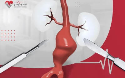 تعرف إلى طرق علاج تمدد الشريان الأورطي البطني