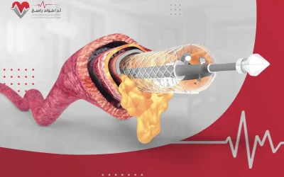 كل ما تود معرفته عن عملية تسليك شرايين القلب عبر القسطرة