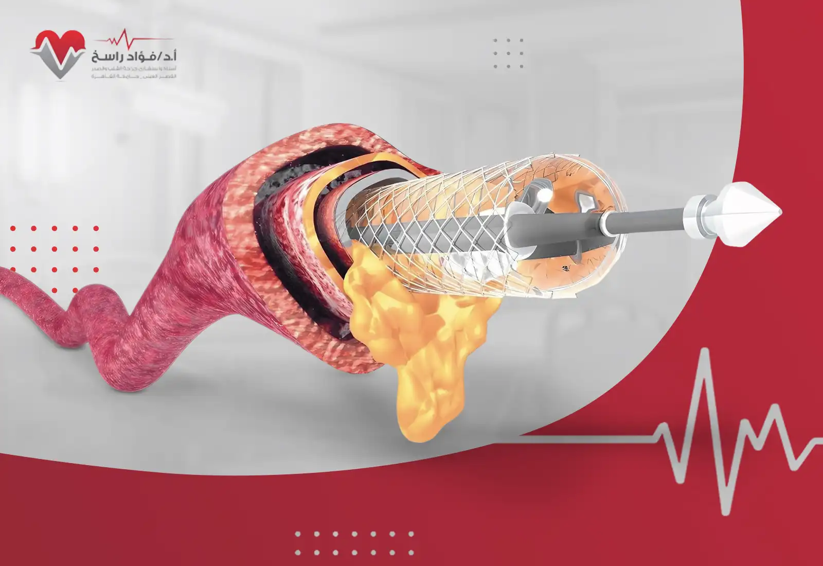 عملية تسليك شرايين القلب