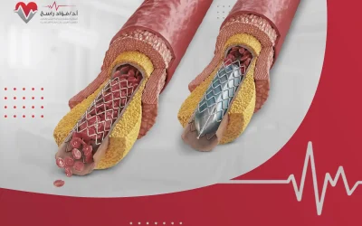 ما الفرق بين الدعامة والبالون في توسيع الشرايين؟